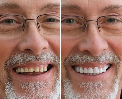 BlissBite™ Snap-On Veneers