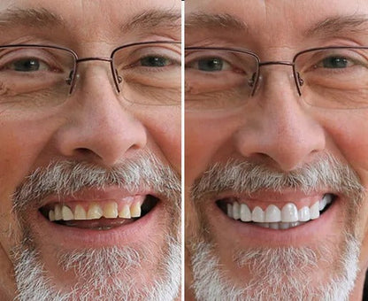 BlissBite™ Snap-On Veneers